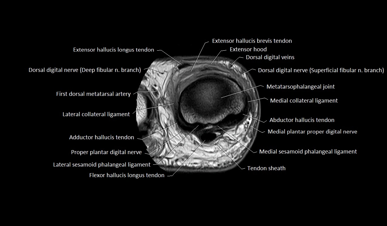 Great toe (hallux) axial microanatomy 3T MRI image 23.webp